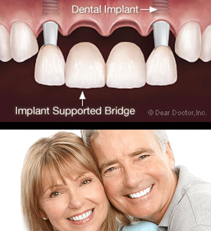 Oral Implants & Bridges & Dentures image