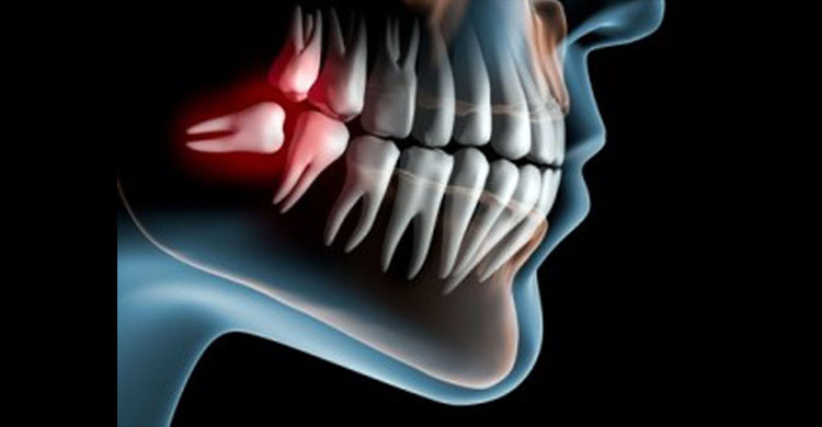 Wisdom Tooth Removal image